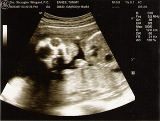 ultrasound pic